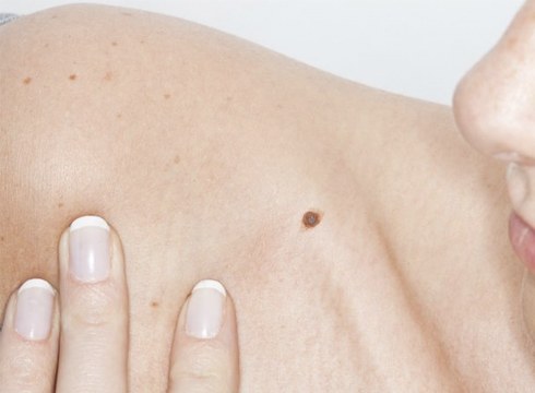 Azaleko minbiziaren aurkako kanpainaren harira, melanina maila neurtzen ibiliko dira bihar AECC elkartekoak